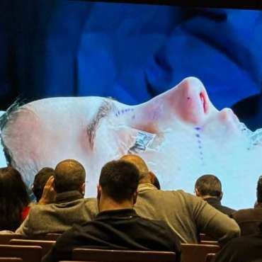 Erhan Coşkun, MD: Closed Polygon Tip Low Septal Strip Dorsal Y Modification Cartilage Only Dorsal Preservation - Live Surgery (4th Bergamo-Istanbul Course)