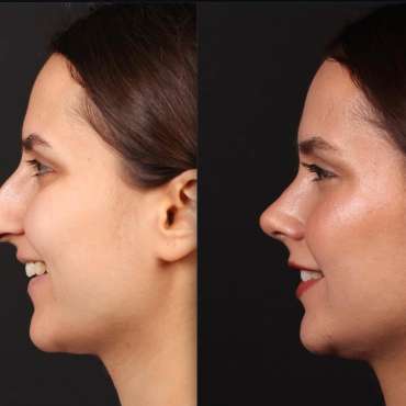 Assoc. Prof. Barış Çakır: Open Approach Ligament Preservation in Primary Rhinoplasty – Live Surgery