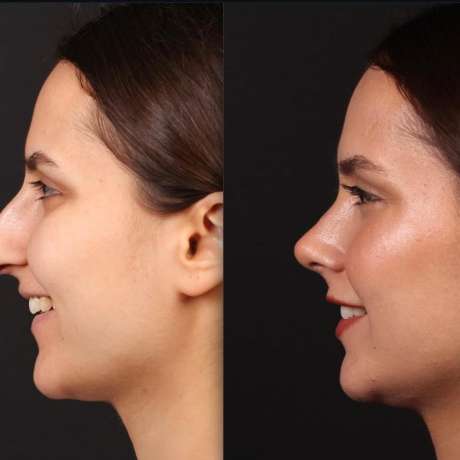 Assoc. Prof. Barış Çakır: Open Approach Ligament Preservation in Primary Rhinoplasty – Live Surgery