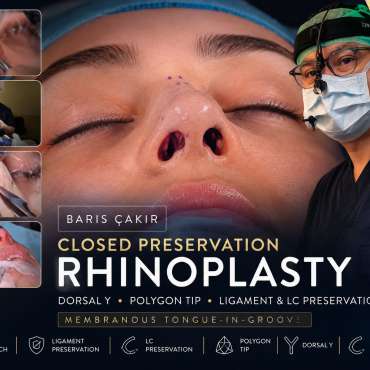 Barış Çakır – Live Surgery: Closed Preservation Rhinoplasty (Dorsal Y, Polygon Tip & Ligament Preservation)