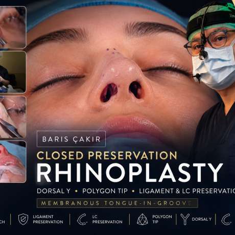 Barış Çakır – Live Surgery: Closed Preservation Rhinoplasty (Dorsal Y, Polygon Tip & Ligament Preservation)