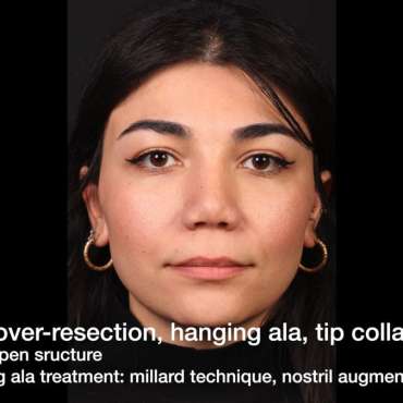 Assoc. Prof. Barış Çakır: Nostril Over-Resection & Hanging Ala Correction
